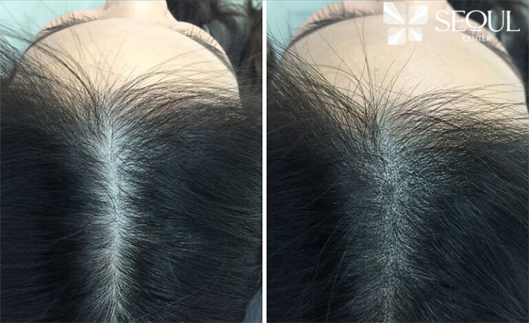 Phun xăm tóc giúp khách hàng cởi bỏ mặc cảm do khuyết điểm tóc thưa hói
