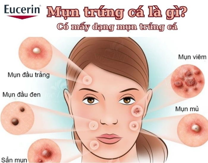 Mụn trứng cá: Nguyên nhân, triệu chứng và cách trị mụn trứng cá