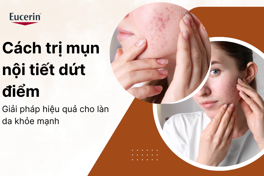 Cách trị mụn nội tiết dứt điểm