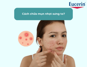 cach20chua20mun20nhot20sung20to