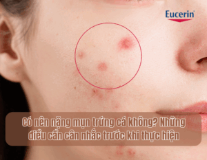 co20nen20nang20mun20trung20ca20khong nhung20dieu20can20can20nhac20truoc20khi20thuc20hien