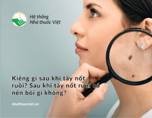 kieng gi sau khi tay not ruoi