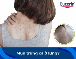 mun20trung20ca20o20lung